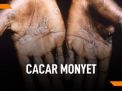 Kemenkes Konfirmasi Temuan Pasien Pertama Cacar Monyet Di Jakarta