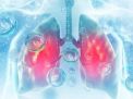Alami Peningkatan, 8.080 Balita Di Surabaya Terjangkit Pneumonia