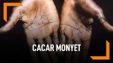 Kemenkes Konfirmasi Temuan Pasien Pertama Cacar Monyet Di Jakarta