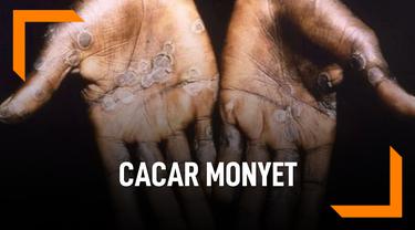 Beda Cacar Monyet dan Cacar Biasa (dok: Liputan 6)