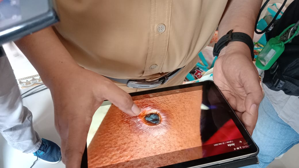 Kepala Dinas Kesehatan Tulungagung, Kasil Rokhmat saat menunjukkan luka yang disebabkan oleh bakteri anthrax 