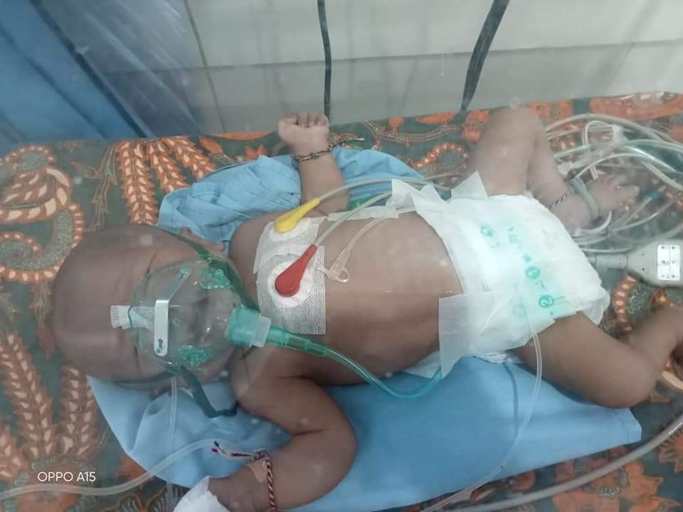 Reskiano Al Fatih, seorang bayi laki-laki yang baru berusia 5 bulan penderita penyakit penyakit jantung bawaan.